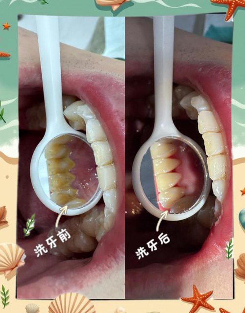 洗牙：守护口腔健康的关键一步